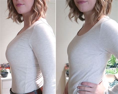 tiny boobs|425cc, 5.5 weeks PO. Boobs look tiny. How much can they drop。